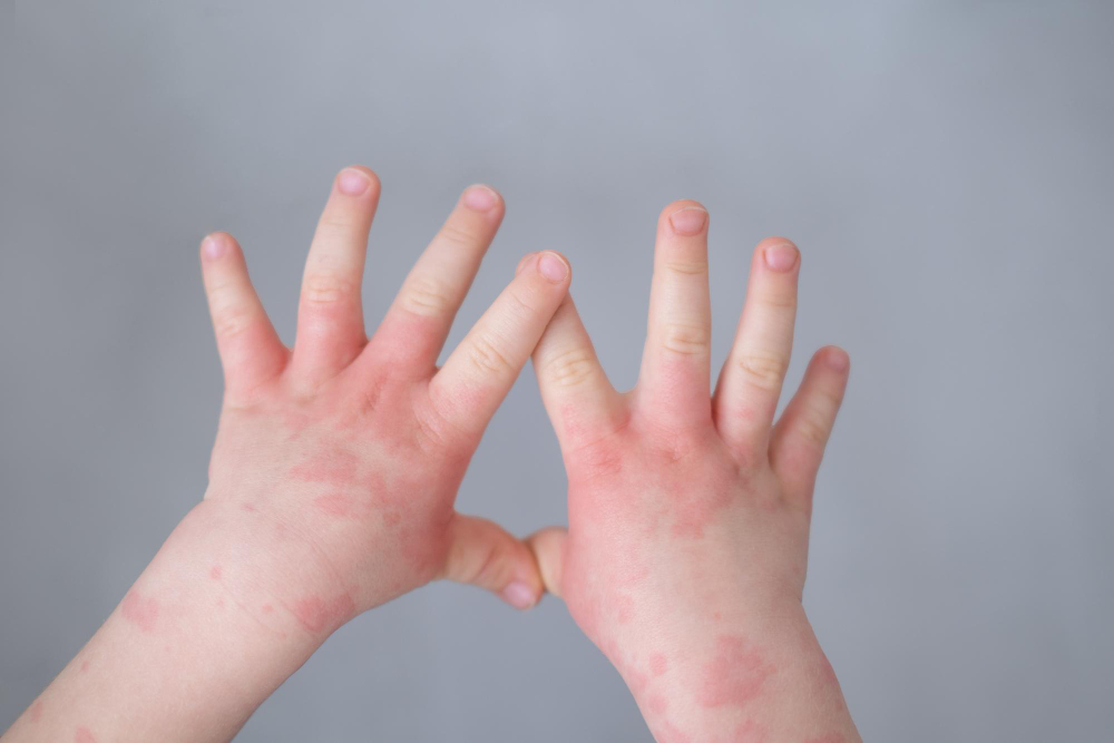 Kas yra atopinis dermatitas?