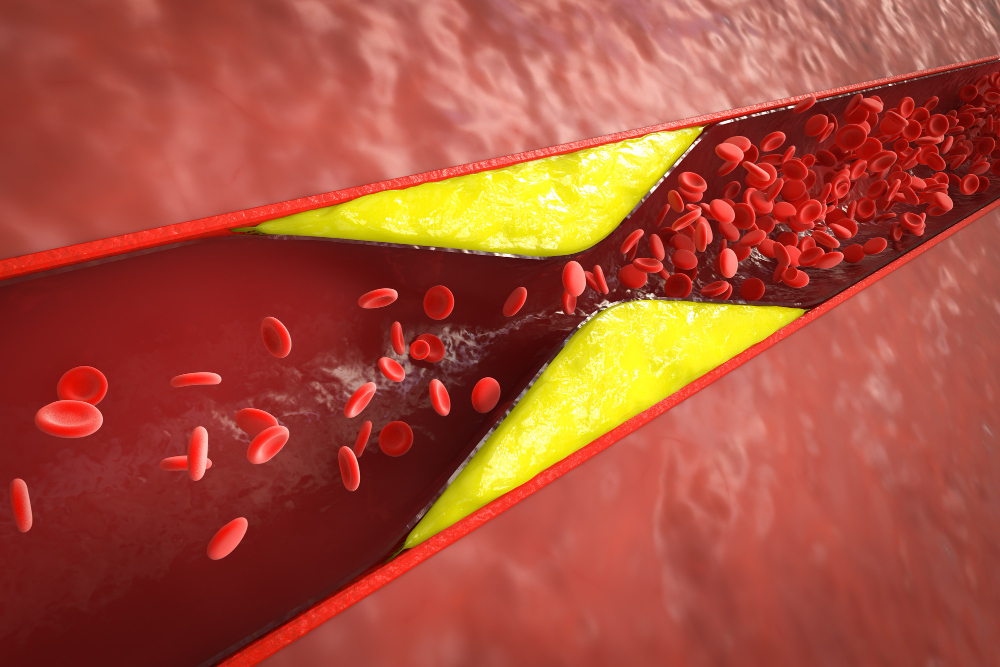 Aukštas cholesterolis: ką valgyti, kad sumažintumėte riziką