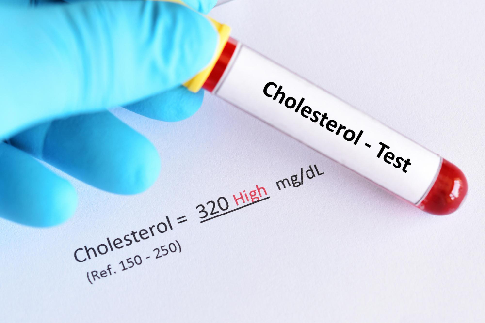 Didelis cholesterolis: ką valgyti vietoj įprastų patiekalų