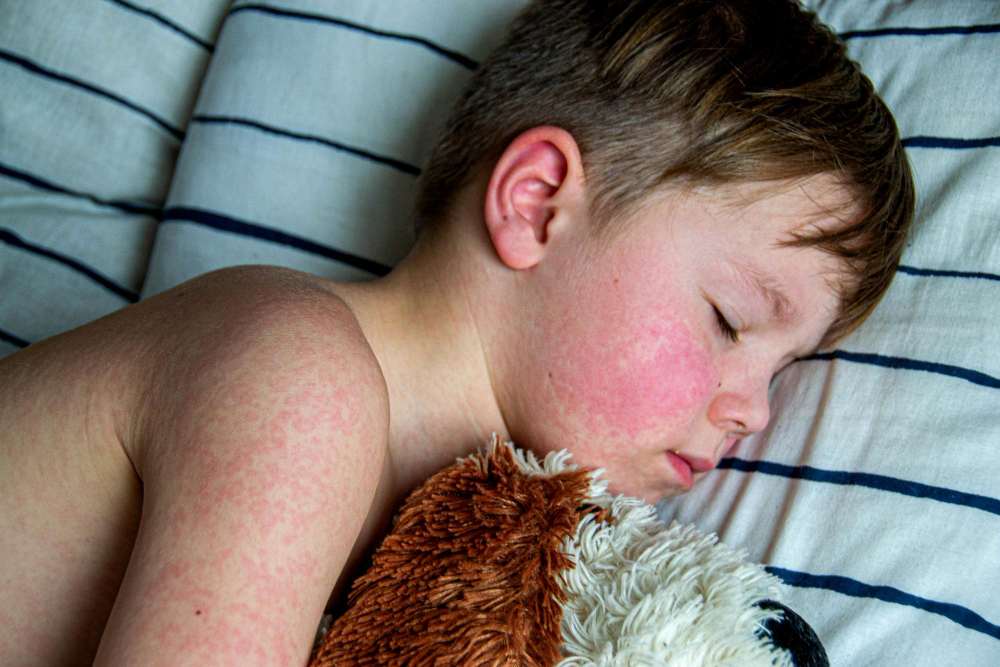 Kada bėrimas būna virusinis?