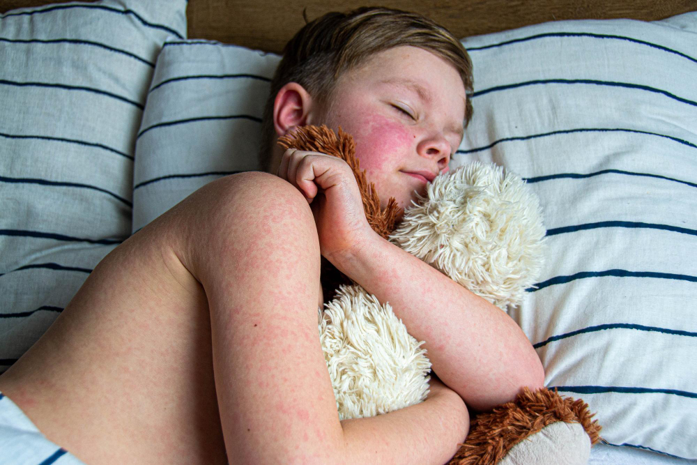 Virusinis bėrimas vaikui: kuo skiriasi nuo alerginio