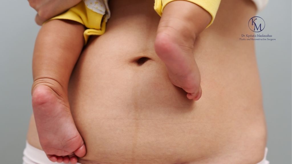 Mommy makeover rezultatų ilgaamžiškumas: kas turi didžiausią įtaką pokyčių išlaikymui?