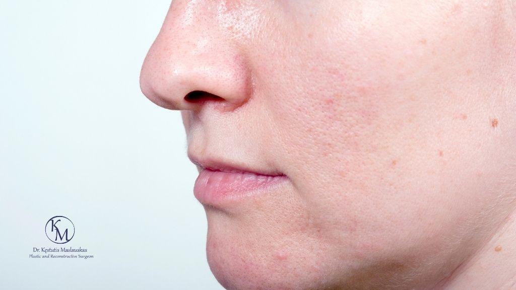 Rinoplastika užsienyje ar Lietuvoje: ką svarbu įvertinti prieš renkantis?